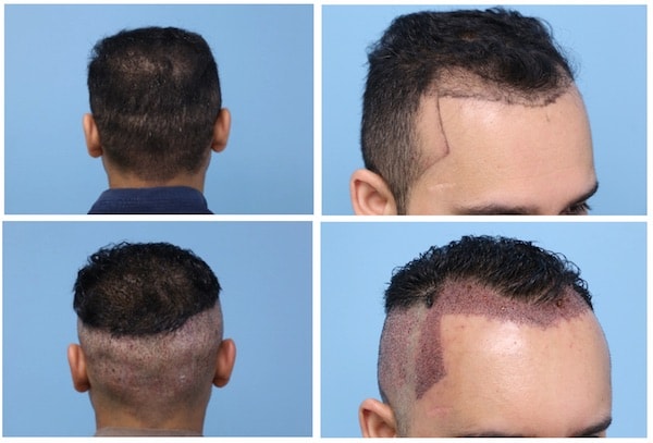 Partial Shave before having a FUE hair transplant