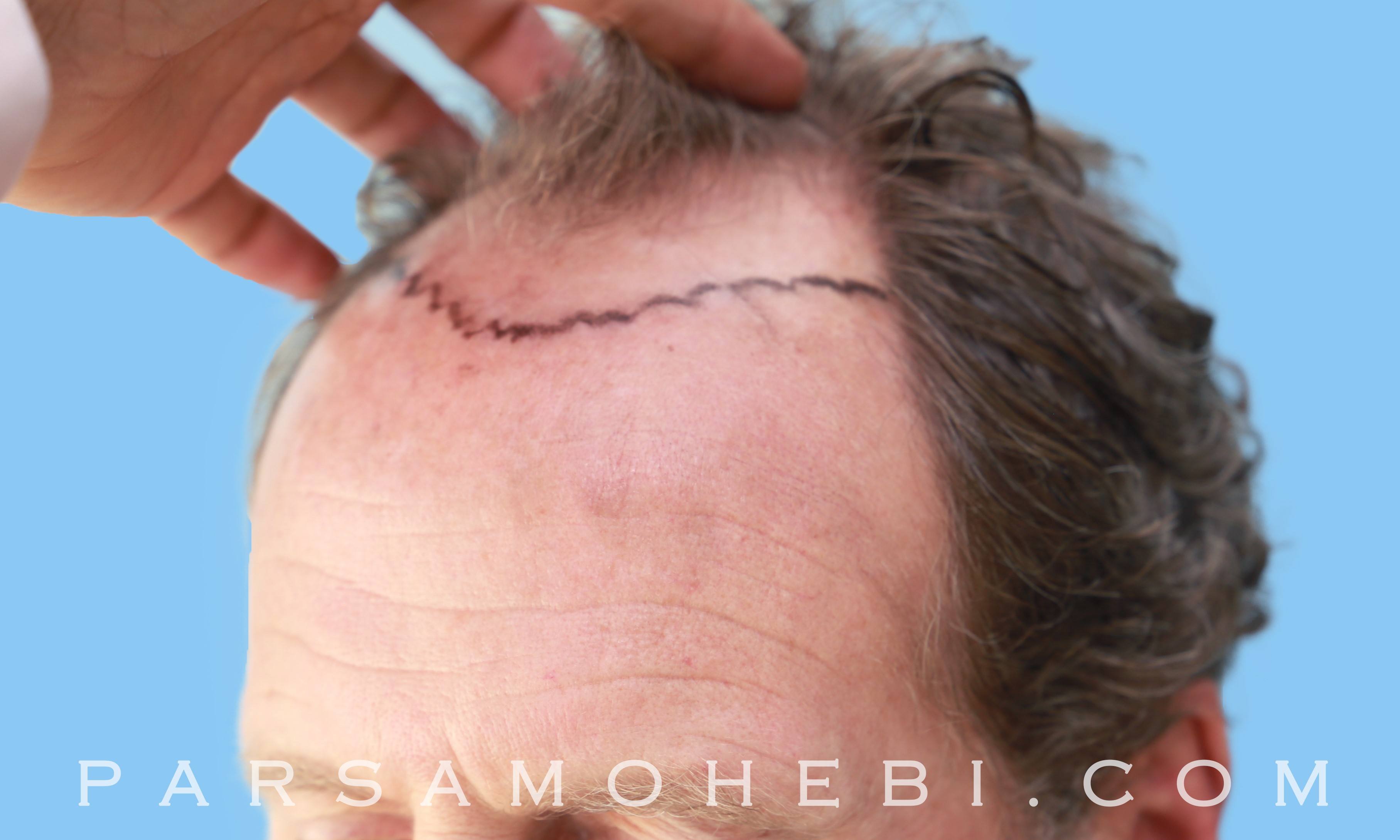 Before and After FUE Hair Transplant (2,220). One Procedure. 8 Months