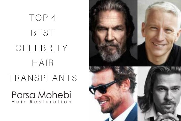 Top 4 Best Celebrity Hair Transplants | Parsa Mohebi Hair Restoration