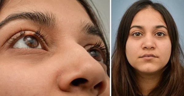 before and after eyelash transplant surgery