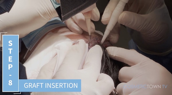 fue graft insertion