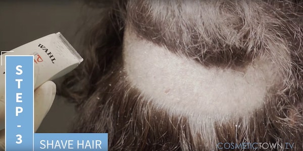 hair shaving for fue hair transplant