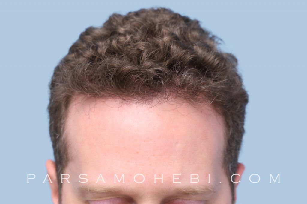 Before and After FUE Hair Transplant (1,760). One Procedure. 8 Months
