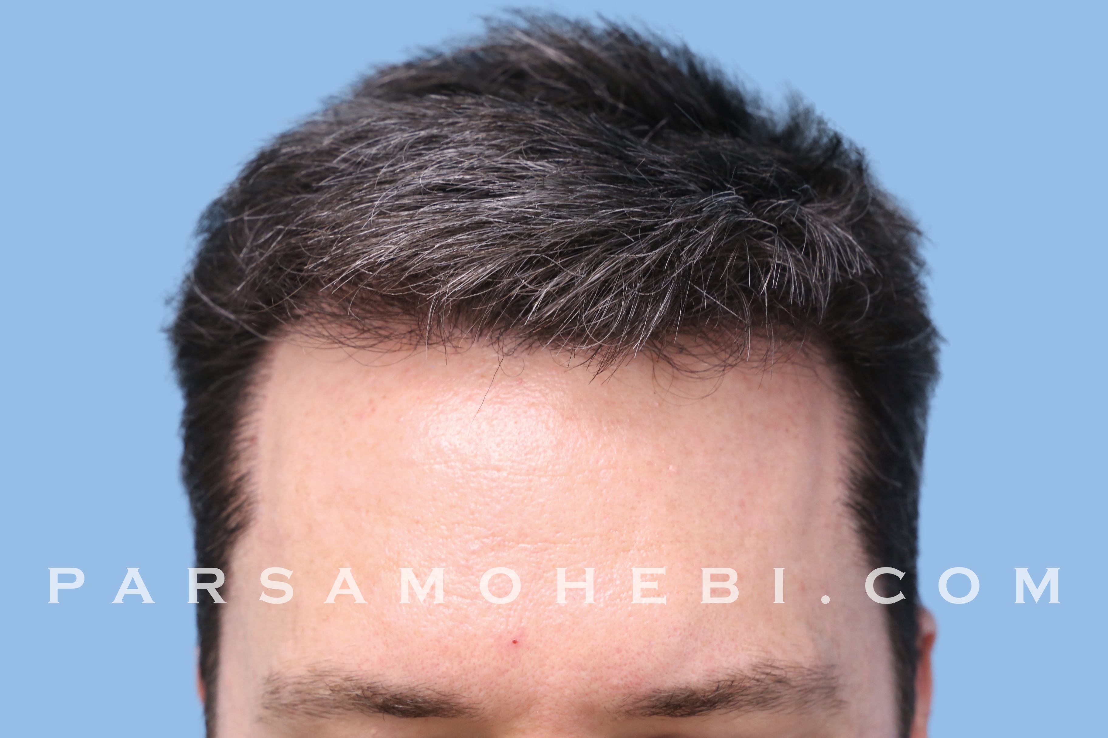 Before and After FUE Hair Transplant (2,179). One Procedure. 8 Months  Elapsed - Parsa Mohebi Hair Restoration - Parsa Mohebi Hair Restoration