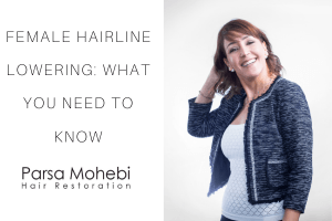 female hairline lowering - everything you need to know