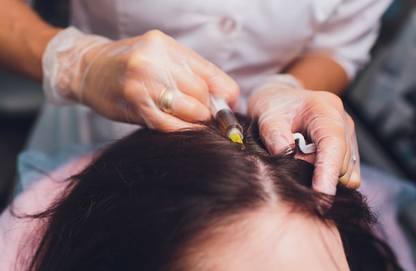 PRP treatment for hair loss 