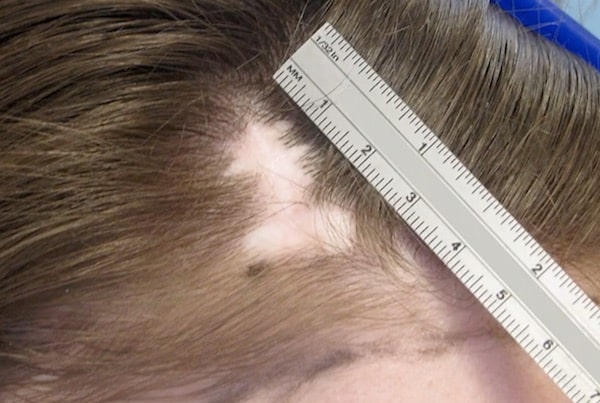 FUE hair transplant for scalp scar revision