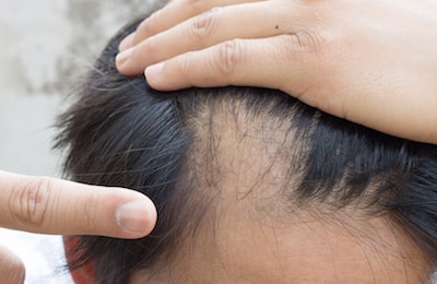 Alopecia Areata cause of hair loss and balding