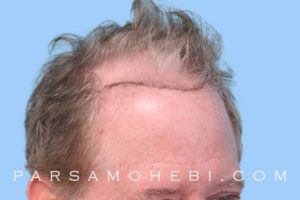 this is an image of hair transplant patient in Bernal Heights