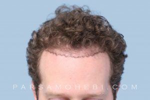 this is an image of hair transplant patient in Beverly Glen