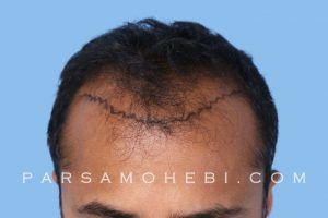 this is an image of hair transplant patient in Beverly Grove