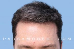 this is an image of hair transplant patient in Beverlywood