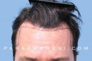this is an image of hair transplant patient in Beverlywood