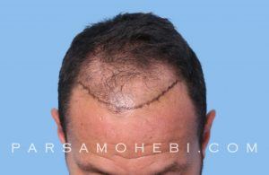 this is an image of hair transplant patient in Brisbane