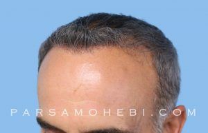 this is an image of hair transplant patient in Diamond Heights