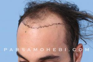 this is an image of hair transplant patient in Dolores Heights