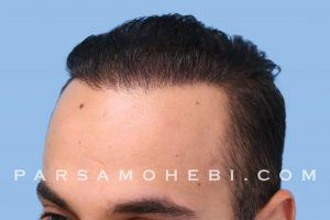 this is an image of hair transplant patient in Dolores Heights