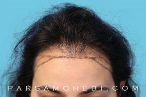 this is an image of hair transplant patient in Emeryville