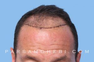 this is an image of hair transplant patient in Glen Park