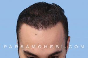 this is an image of hair transplant patient in Haight Ashbury