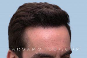 this is an image of hair transplant patient in Hollywood