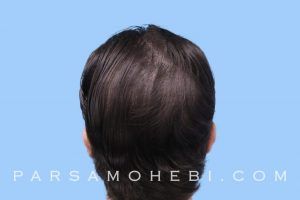 this is an image of hair transplant patient from LA