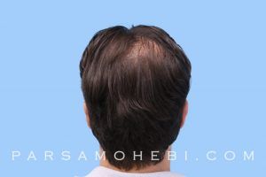 this is an image of hair transplant patient in LA
