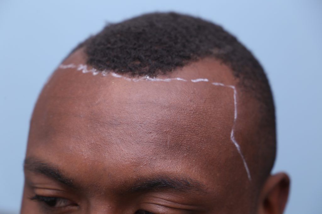 Millbrae-before-hair-transplant | Hair Transplants Los Angeles & San
