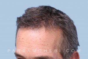this is an image of hair transplant patient in Northridge