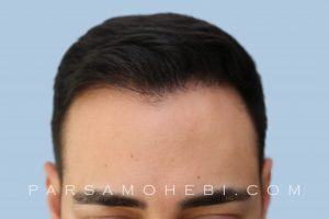 this is an image of hair transplant patient in Oakland