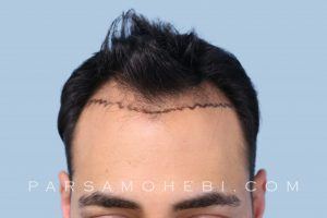 this is an image of hair transplant patient in Oakland