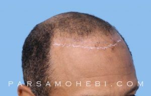 this is an image of hair transplant patient in Outer Mission