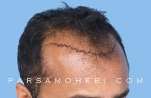 this is an image of hair transplant patient in Pacific Heights