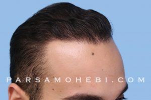 this is an image of hair transplant patient in Portola
