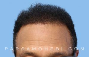 this is an image of hair transplant patient in Potrero Hill