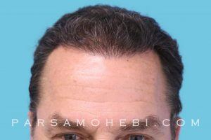 this is an image of hair transplant patient in Presidio Heights