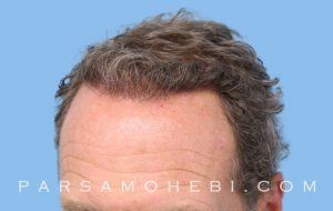 this is an image of hair transplant patient in Russian Hill