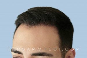 this is an image of hair transplant patient in San Bruno
