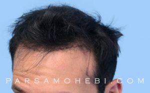 this is an image of hair transplant patient in Sherman Oaks