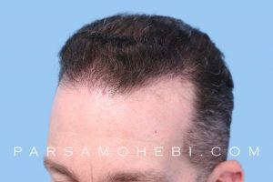 this is an image of hair transplant patient in South San Francisco