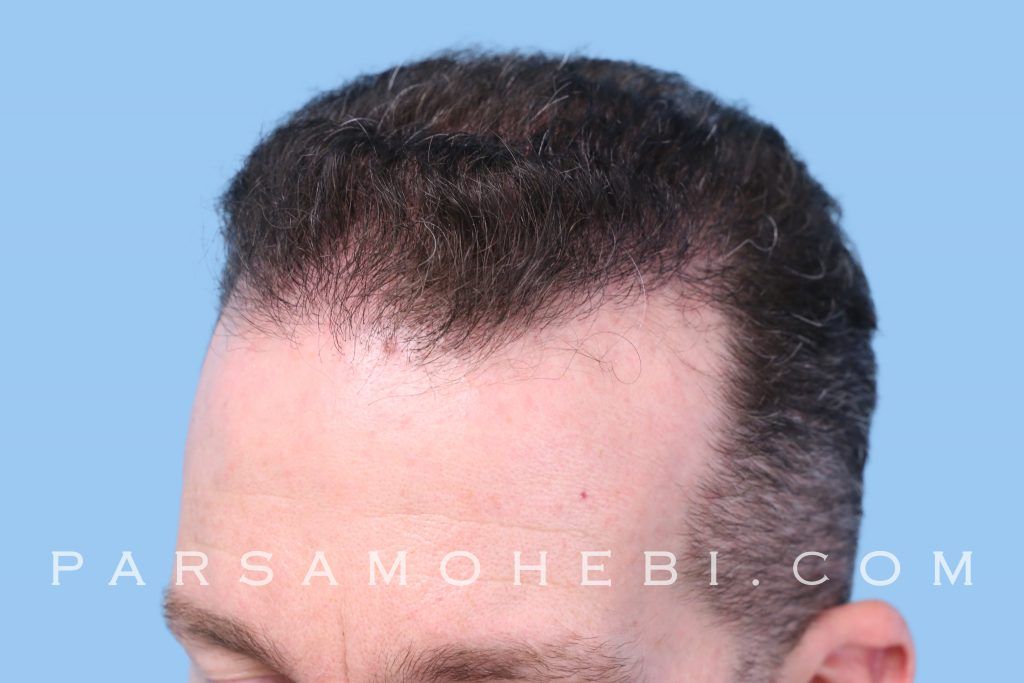 South San Francisco Hair Transplant Parsa Mohebi Hair Restoration