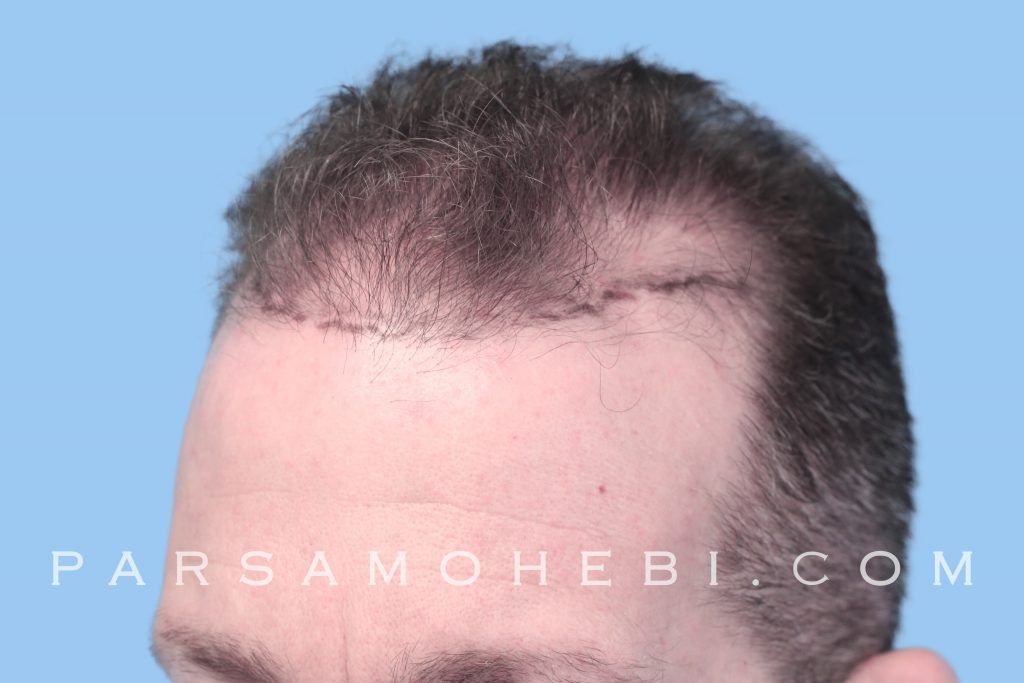 South San Francisco Hair Transplant Parsa Mohebi Hair Restoration