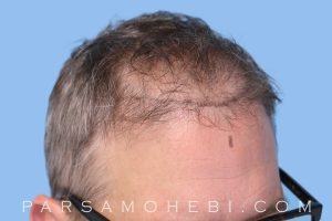 this is an image of hair transplant patient in Valley Glen