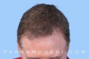 this is an image of hair transplant patient in Vinci