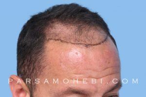this is an image of hair transplant patient in Visitacion Valley