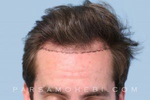 this is an image of hair transplant patient in West Hollywood
