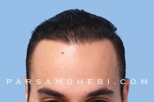 this is a hair transplant patient in Westwood