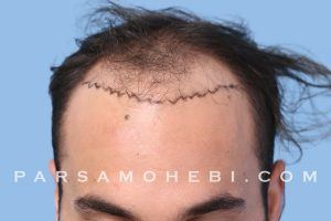 this is a image of hair transplant patient in Westwood