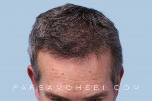 this is an image of hair transplant patient in Holmby Hills