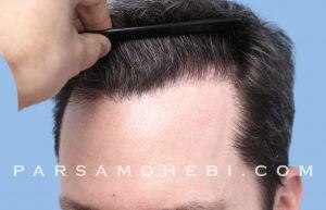 this is an image of hair transplant patient in SoMa